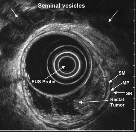 Eus Image Of T1 Rectal Cancer Confined To Mucosa And Su Open I