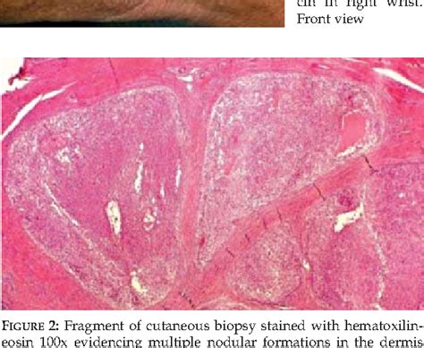 Figure 1 From Poorly Differentiated Synovial Sarcoma In The Wrist