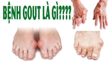 BỆnh Gout TriỆu ChỨng NguyÊn NhÂn ChẾ ĐỘ Dinh DƯỠng