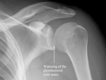 Posterior Shoulder Dislocation • LITFL Medical Blog • Trauma