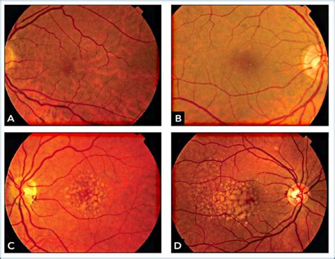 Perfil epidemiológico de pacientes degeneração macular relacionada