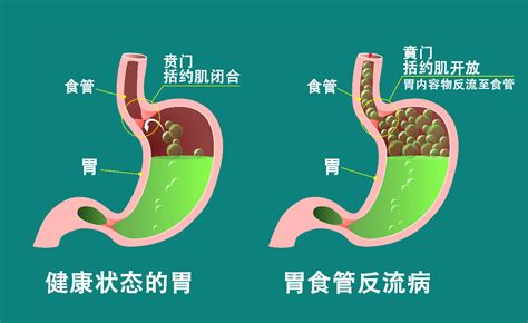 胃食管反流病为何难诊断？ 孚维尔生物医疗