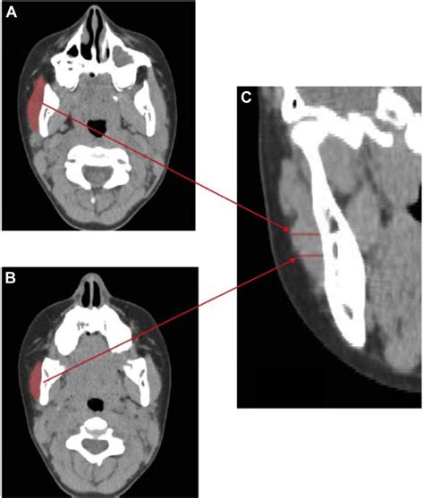 Estimation Of Masseter Muscle Volume A And B Superior Views Of Two Download Scientific