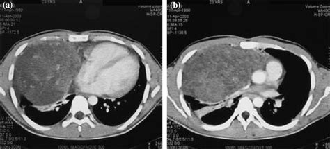 A Rare Case Of Large Mediastinal Germ Cell Tumor Detected By