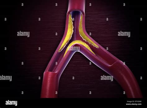 What Is Abdominal Aortic Atherosclerosis