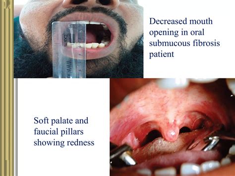 Oral Submucous Fibrosis Ppt Ppt