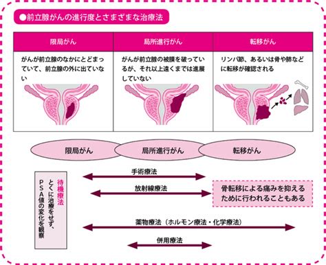 前立腺がんの「リスク分類」と「治療法の選択」 がんプラス