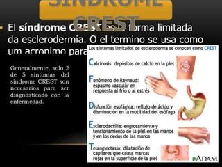 Esclerodermia Ppt