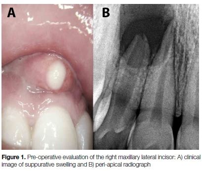 Resolution Of A Large Periapical Lesion In An Immature Maxillary