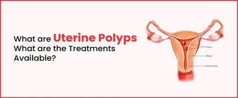 Uterine Polyps Causes Symptoms And Treatment Imprimis Ivf