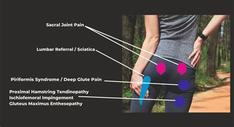 Hip Pain Location Diagram Anterior, Posterior, Lateral View, 59% OFF