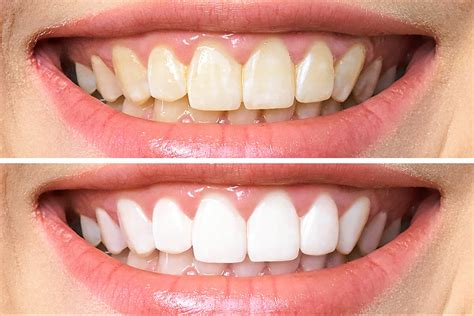 Cost Of Teeth Whitening In Australia 2021 Peel Dental Studio Dentist