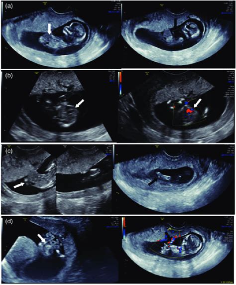 Sonogram Of The Fetus At 12 Weeks Gestation A Defect Of The