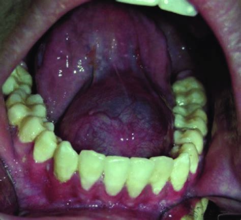 Photograph Of Oral Ranula Showing Bluish Appearance Suggesting