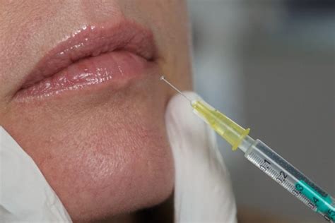 Em quais casos o plano de saúde deve custear a aplicação de botox