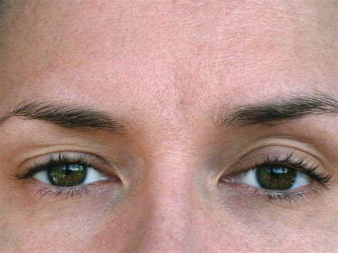 Palpebral Ptosis Or Drooping Eyelids What Is The Best Solution