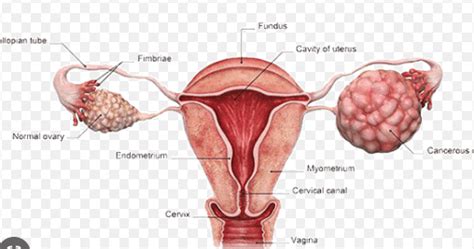 Krukenberg Procedure: What It Is and How It Can Help Treat Ovarian ...