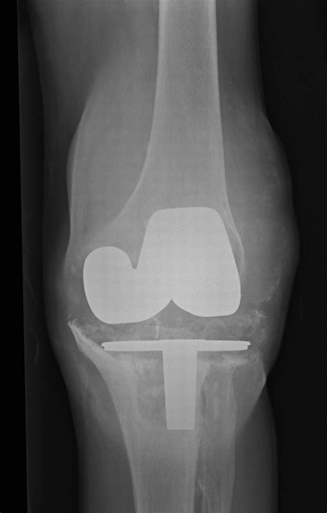 The Management Of Bone Loss In Revision Total Knee Replacement Bone