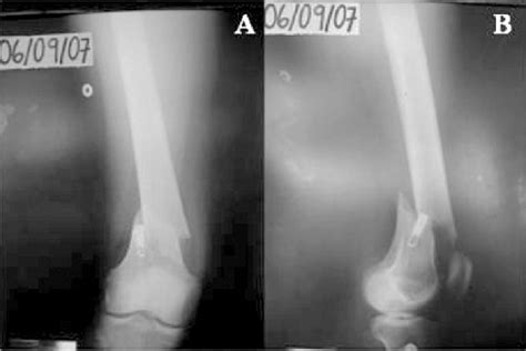 Radiografia Ntero Posterior A E Perfil B Exibindo Fratura Supra