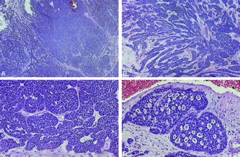 Sinonasal Basaloid Squamous Cell Carcinoma Shows A Variety Of Growth