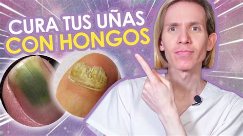 Como Curar Los Hongos En Las UÑas Guía Para Resolver Onicomicosis De