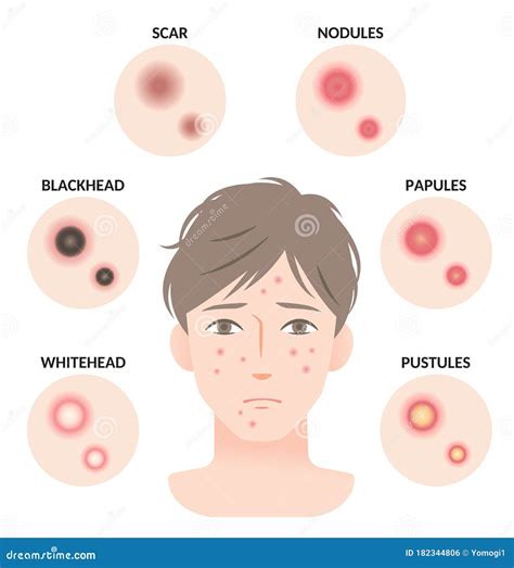 Types Of Acne And Man Face Illustration Whitehead Black Head Papules