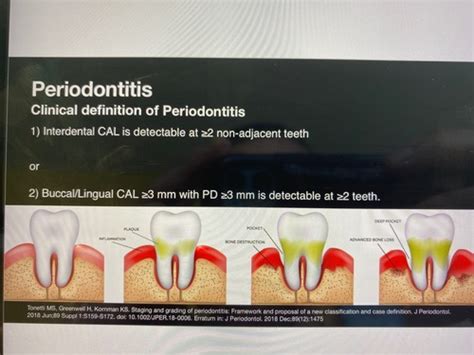 Perio Iii Flashcards Quizlet
