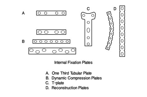 Internal Fixation - orthopedics