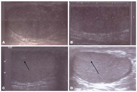 Testicular Adrenal Rest Tumors In Congential Adrenal Hyperlasia A Case