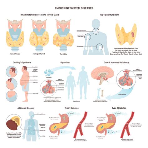 Premium Vector Endocrine System Organ Disease Set Human Glands