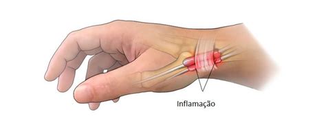 Dor No Quadril Dr Honorato