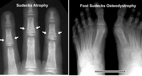 Sudeck S Atrophy Complex Regional Pain Syndrome Treatment