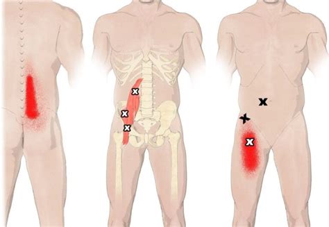 Cuanto Tarda En Curarse Una Tendinitis De Cadera Cavitaciones