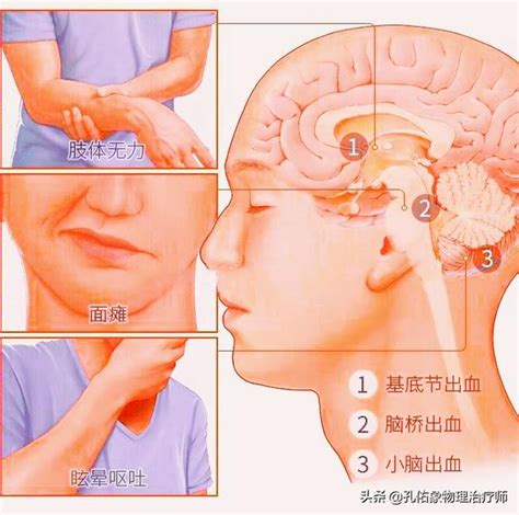 突發腦出血咋辦？本文教您急救方法，有高血壓、高血糖的人請收藏 每日頭條