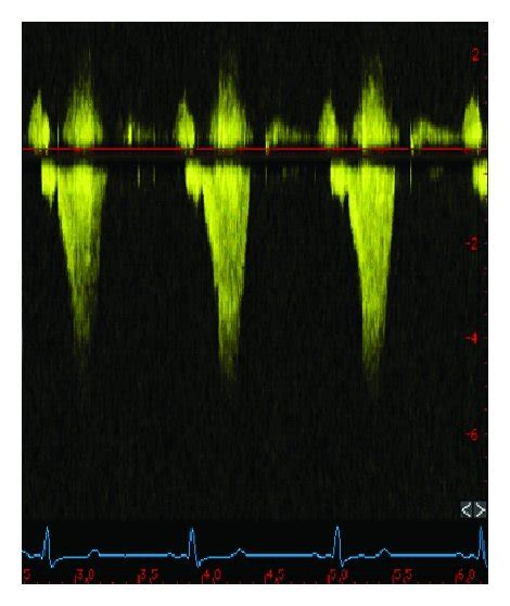 Echocardiographic aspect of HOCM before/after a myectomy ((a)–(d)) and ...