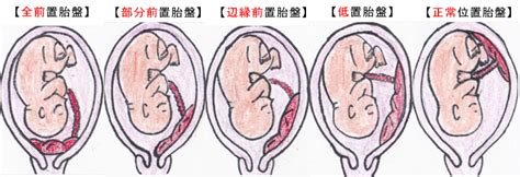 駅歩1分前置胎盤・低置胎盤専門の鍼灸院｜胎盤は鍼灸で改善