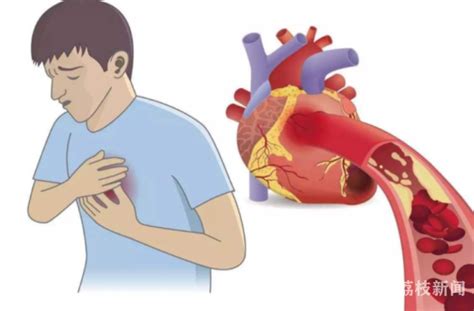 常规体检“救”下急性心梗患者 医生提醒：心梗救治越早越好我苏网