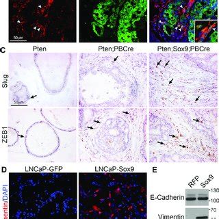 Sox Promotes Epithelial To Mesenchymal Transition In Pten Mutant