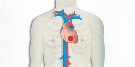 ¿qué Es La Cardiopatía Isquémica