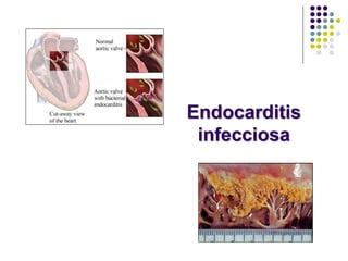 Tema Bacteriemia Y Endocarditis Infecciosa Ppt