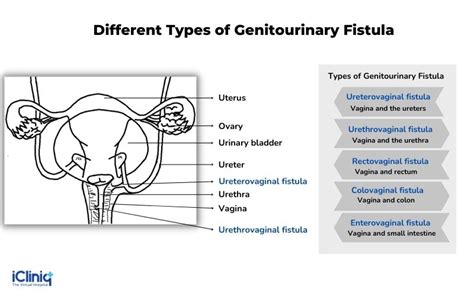 What Is A Urethrovaginal Fistula