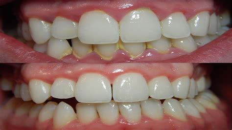 Cómo prevenir la gingivitis Sumuela