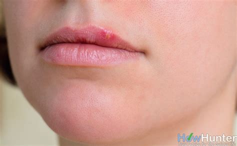 Water Blisters On Lips Pictures Photos