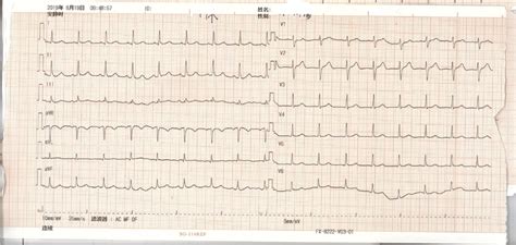 Sinus rhythm of the patient. | Download Scientific Diagram