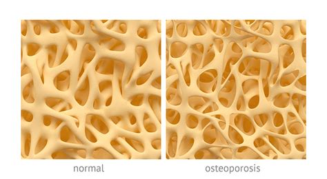 Bone Strengthening For Osteoporosis And Osteopenia Posture Plus