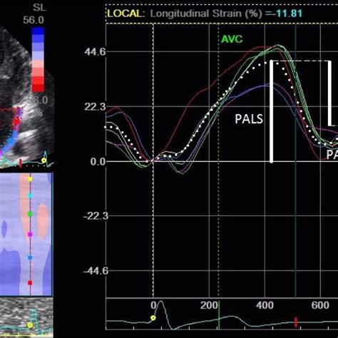 Example Of Left Atrial Strain Curves With Selected Measured