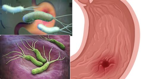 What Is H Pylori YouTube