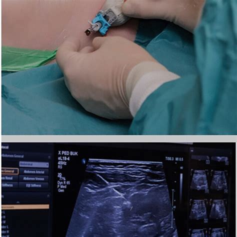 Ultrasound Guided Percutaneous Insertion Of The Distal Catheter