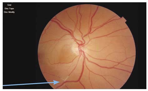 Time Is Vision In Central Retinal Artery Occlusion Eye News