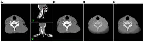 Cone Beam Ct Radiotherapy The Best Picture Of Beam